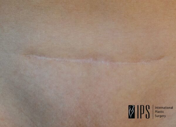 Oporavak nakon abdominoplastike uključuje i negu ožiljka