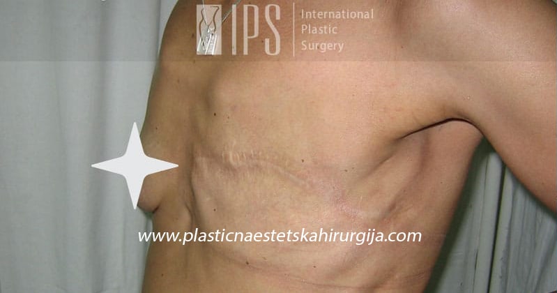 Totalna mastektomija - uklanjanje cele dojke i okolno zahvaćeno tkivo