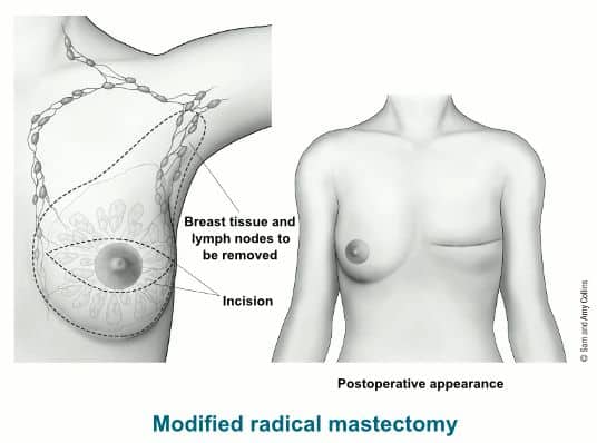 Modifikovana radikalna mastektomija je često korišćena metoda operativnog zahvata