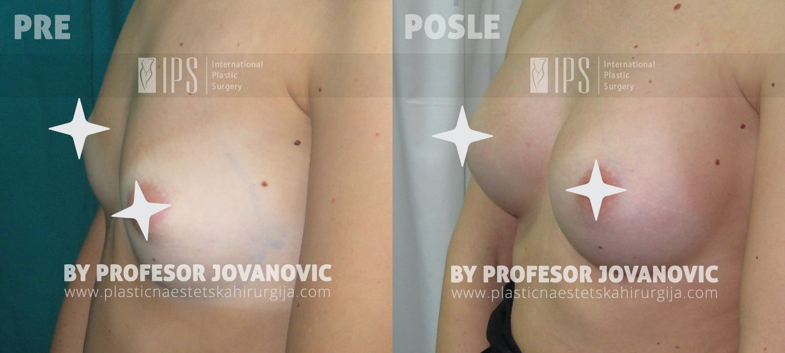 Povećanje grudi anatomskim implantima - pre i posle, levi polubok