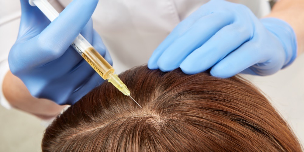PRP terapija u lečenju ćelavosti i opadanja kose