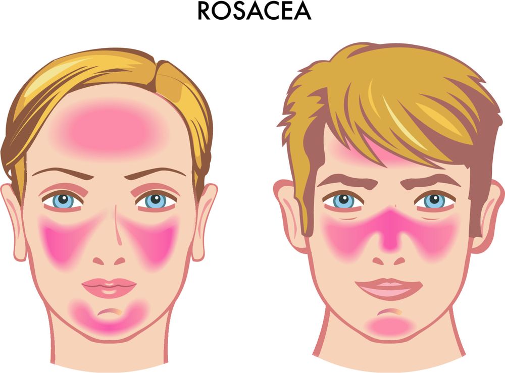 Rozacea je hronična zapaljenjska bolest lojnih žlezda lica
